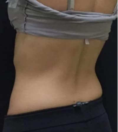 5f89ff215a8bcbaef7a5683a_coolsculpting-69