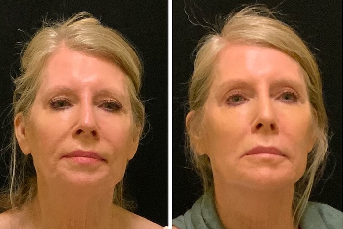 Hush L.A. Medspa - 🧵 Lifting the tip of the nose can make the nose appear  slimmer and more contoured. 🧵 We use PDO threads customized especially for  the nose to lift
